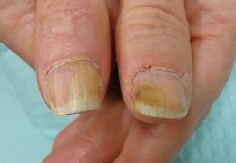 Ногти на руках, болезни ногтей, причины заболевания