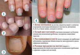 Расслоение ногтей: причины появления и способы лечения Слоятся ногти причина и лечение дома